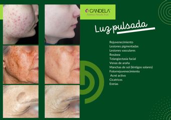 Eliminación de manchas de la piel - Clínica Díaz Caparrós
