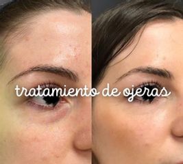 Eliminación de ojeras - Clínica Díaz Caparrós