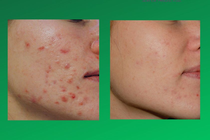 Tratamiento antiacné antes y después - 846437