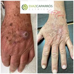 Verrugas - Clínica Díaz Caparrós