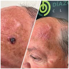 Verrugas - Clínica Díaz Caparrós