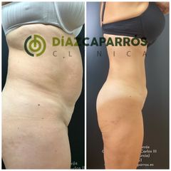 Liposucción - Clínica Díaz Caparrós