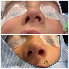 Rinoplastia - Clínica Díaz Caparrós