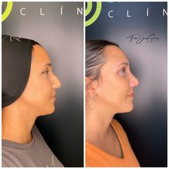 Rinoplastia - Clínica Díaz Caparrós