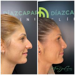 Rinoplastia - Clínica Díaz Caparrós