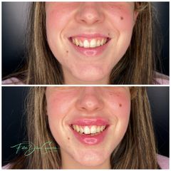 Aumento labios - Clínica Díaz Caparrós