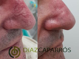 Corrección cicatrices antes y después - 861613