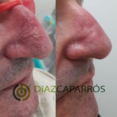 Corrección cicatrices - Clínica Díaz Caparrós