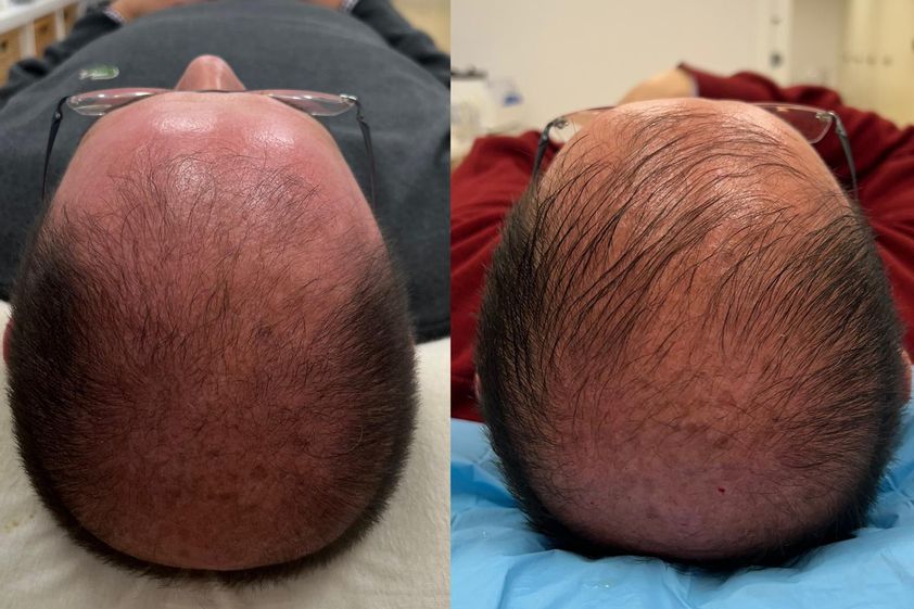 Tratamiento capilar antes y después - 866343