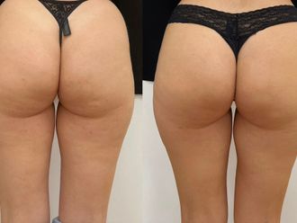 Mesoterapia antes y después - 866345