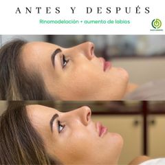 Rinomodelación + Aumento de labios - Clínica Díaz Caparrós