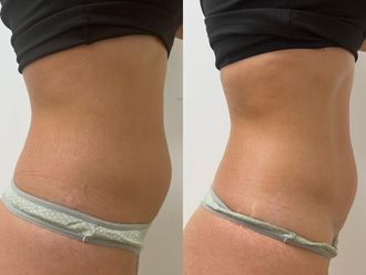 Mesoterapia antes y después - 868623