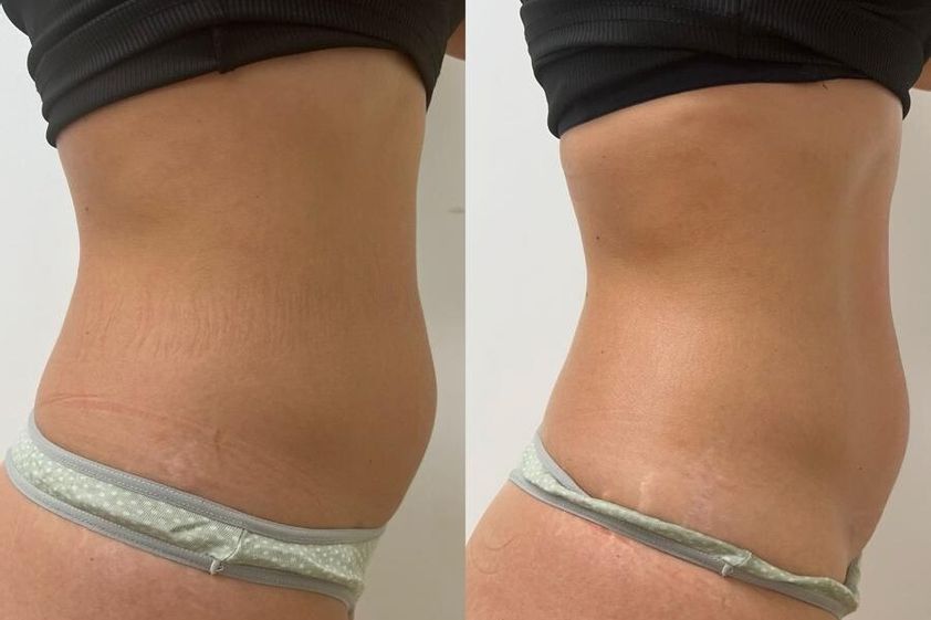 Mesoterapia antes y después - 868623