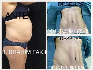 Antes y después Abdominoplastia con liposuccion 
