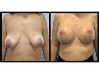 Antes y después mastopexia 