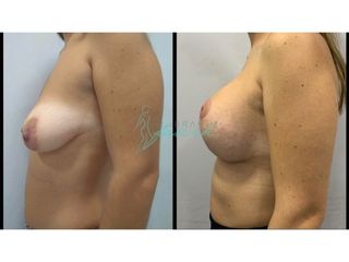 Antes y después mastopexia 