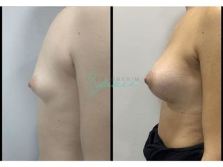 Antes y después Aumento de pecho