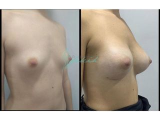 Antes y después Aumento de pecho