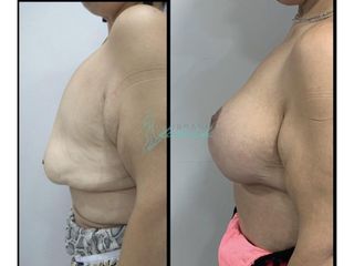 Antes y después Reconstrucción mamaria