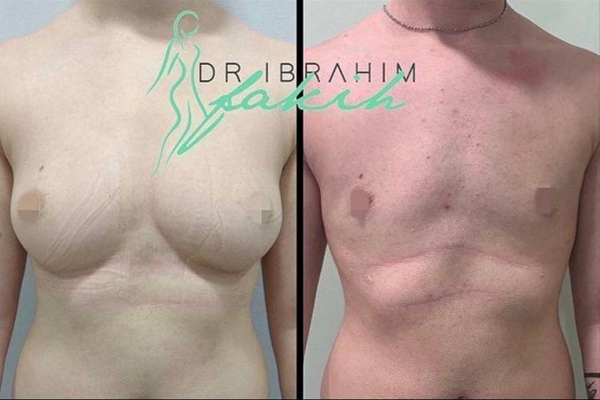 Cambio de sexo antes y después - 664137