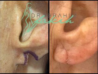 Cirugía de orejas - Dr. Ibrahim Fakih