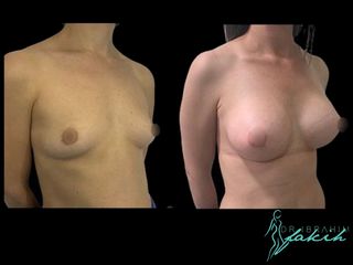 Aumento de pecho - Dr. Ibrahim Fakih