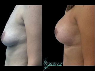 Aumento de pecho - Dr. Ibrahim Fakih