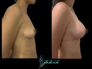 Aumento de pecho - Dr. Ibrahim Fakih