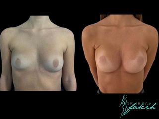 Aumento de pecho - Dr. Ibrahim Fakih
