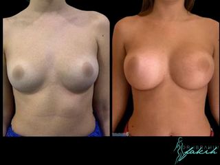 Aumento de pecho - Dr. Ibrahim Fakih