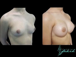 Aumento de pecho - Dr. Ibrahim Fakih