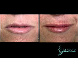 Aumento de labios - Dr. Ibrahim Fakih