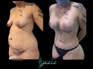 Lipoescultura - Dr. Ibrahim Fakih