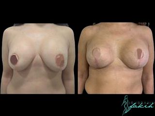 Aumento de pecho - Dr. Ibrahim Fakih