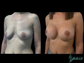 Aumento de pecho - Dr. Ibrahim Fakih