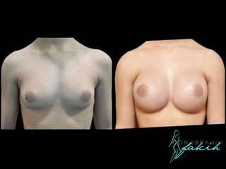 Aumento de pecho - Dr. Ibrahim Fakih