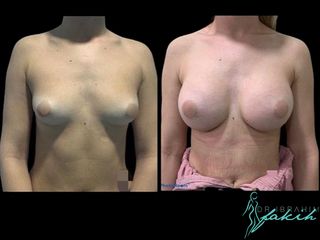 Aumento de pecho - Dr. Ibrahim Fakih