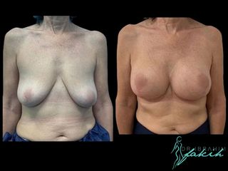Elevación de pecho - Dr. Ibrahim Fakih