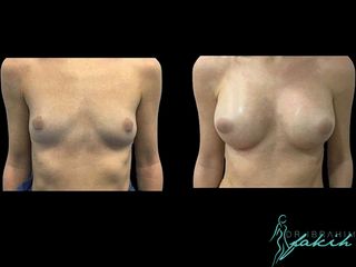 Aumento de pecho - Dr. Ibrahim Fakih