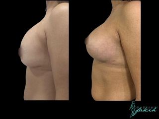 Aumento de pecho - Dr. Ibrahim Fakih