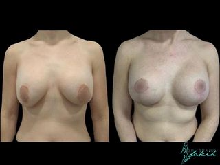 Aumento de pecho - Dr. Ibrahim Fakih