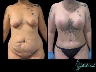 Lipoescultura - Dr. Ibrahim Fakih