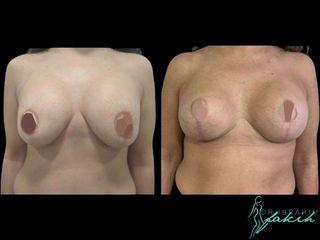 Aumento de pecho - Dr. Ibrahim Fakih