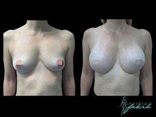 Aumento de pecho - Dr. Ibrahim Fakih