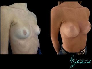 Aumento de pecho - Dr. Ibrahim Fakih