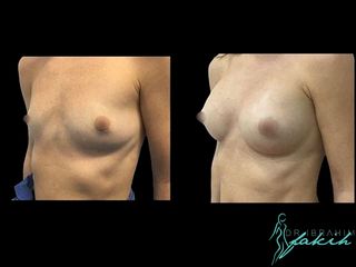 Aumento de pecho - Dr. Ibrahim Fakih