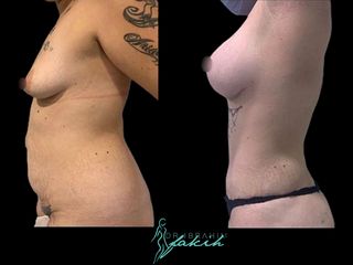 Lipoescultura - Dr. Ibrahim Fakih