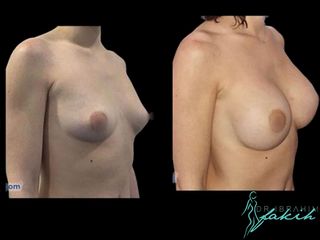 Aumento de pecho - Dr. Ibrahim Fakih