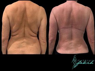 Liposucción - Dr. Ibrahim Fakih