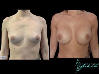 Aumento de pecho - Dr. Ibrahim Fakih